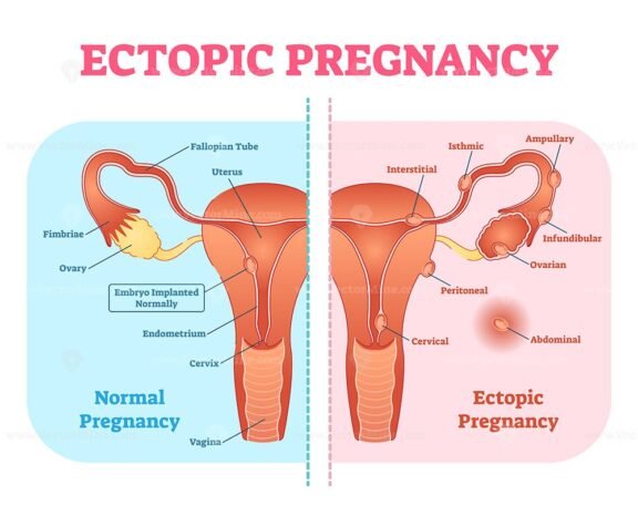 Ectopic Pregnancy