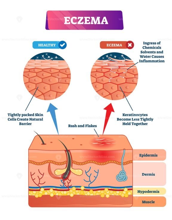 Eczema