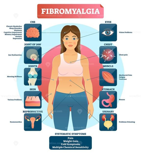 Fibromyalgia