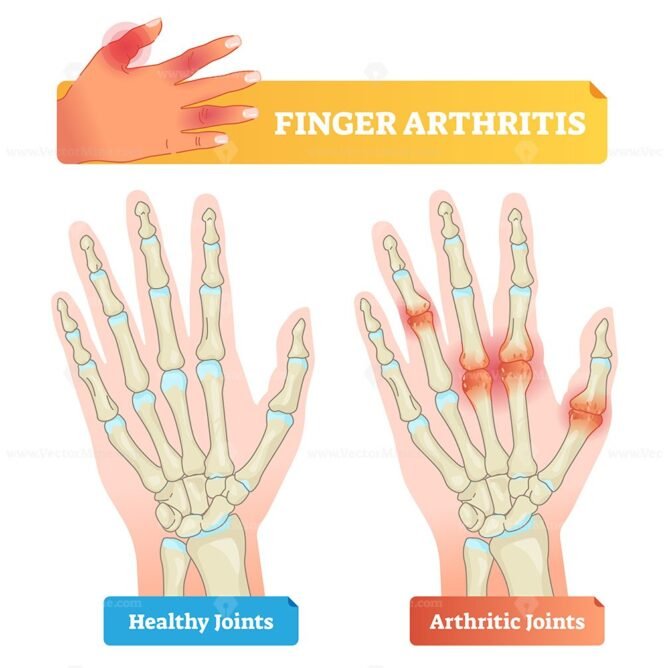 Finger arthritis vector illustration – VectorMine