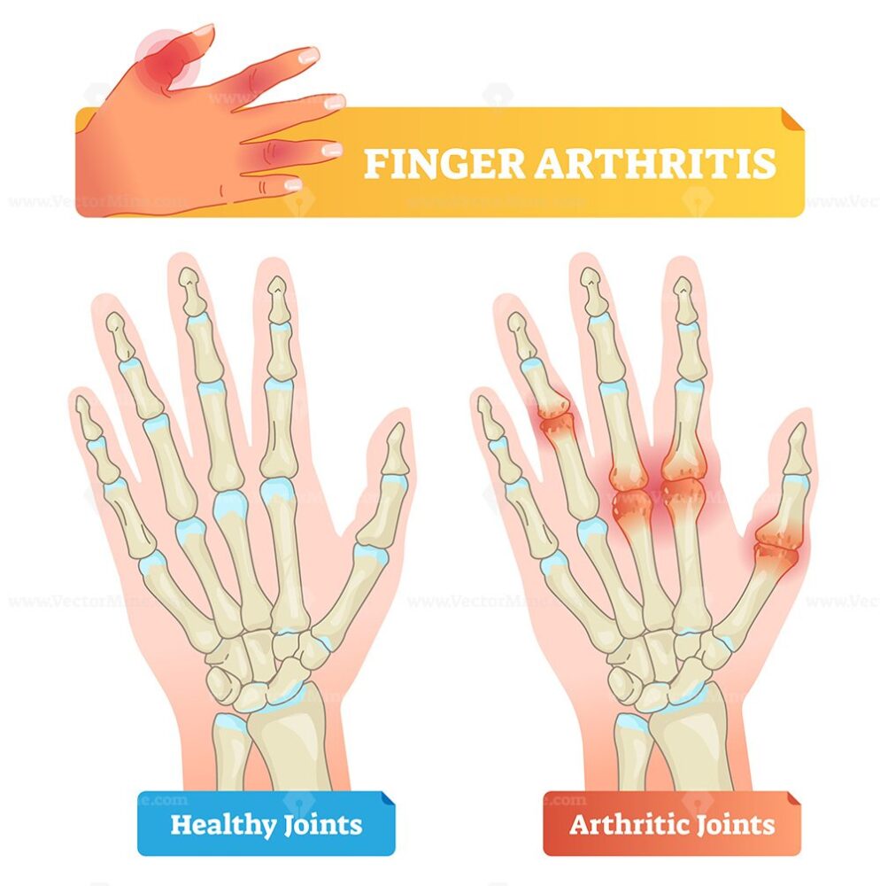 Thumb ulnar collateral ligament as finger injury and problem outline ...