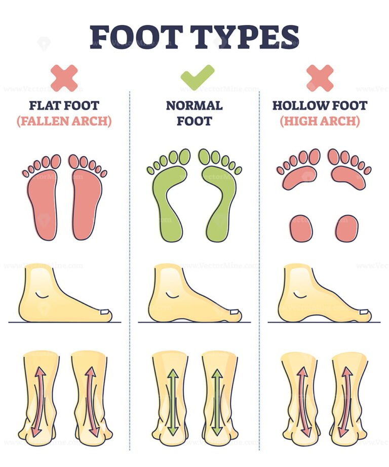 foot-types-with-flat-normal-and-hollow-feet-comparison-in-outline