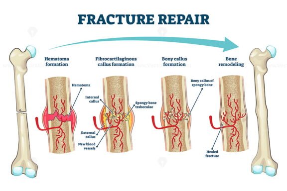 Fracture Repair