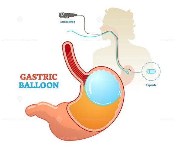 GastricBalloon