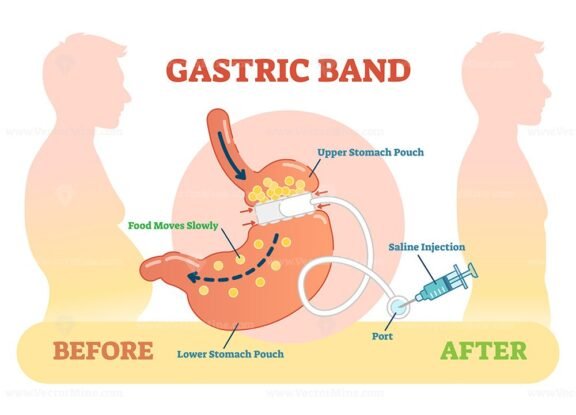 Gastric Band