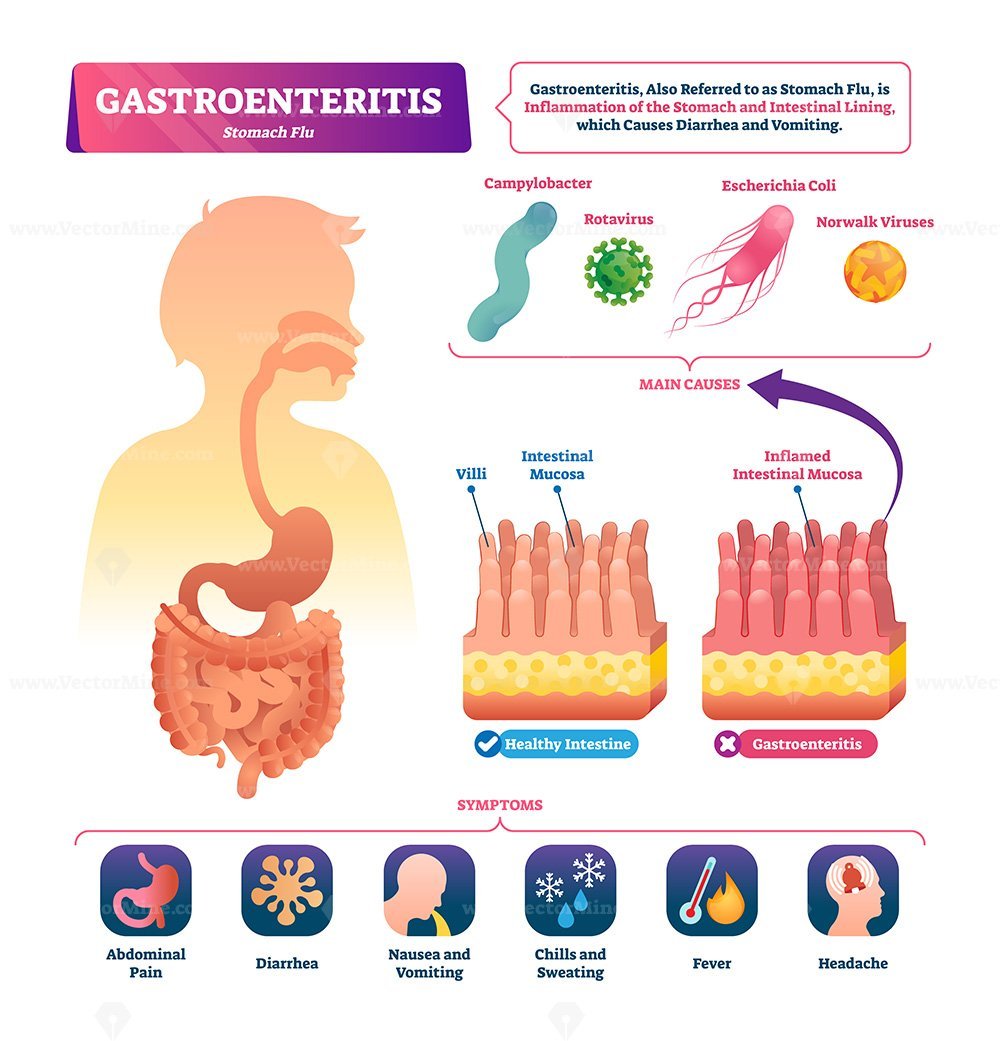 Gastroenteritis vector illustration VectorMine