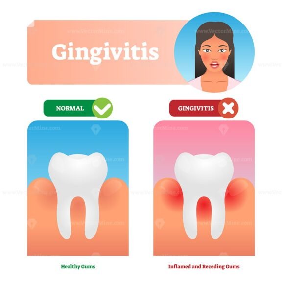 Gingivitis