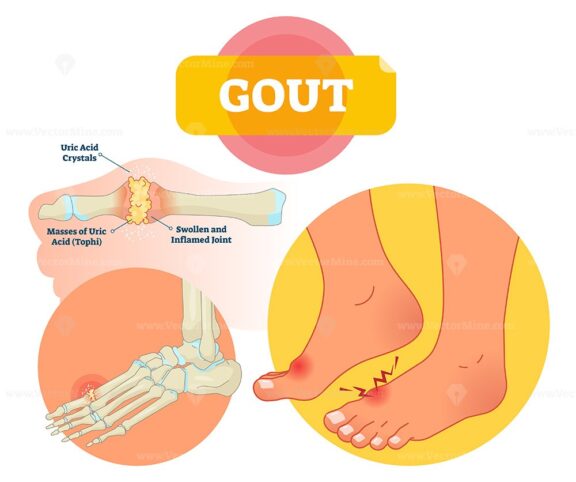 Gout vector illustration