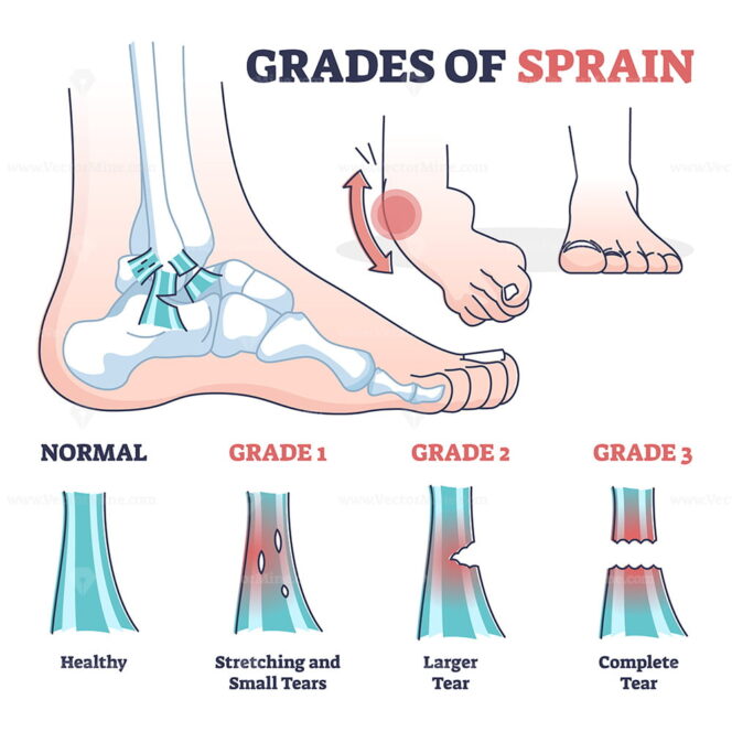 ankle-sprains-situations-with-inversion-and-eversion-injury-outline