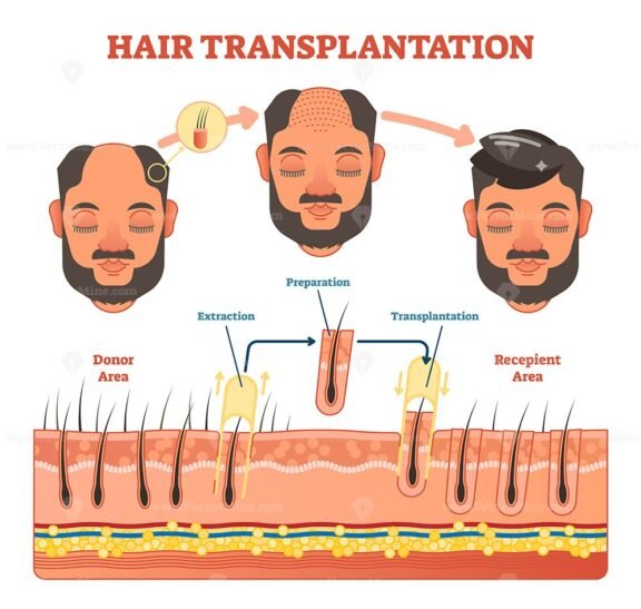 Hair Transplantation