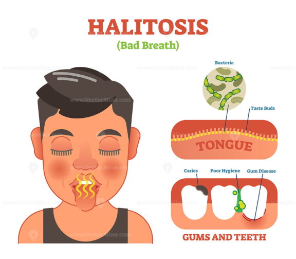 Halitosis - bad breath vector illustration diagram