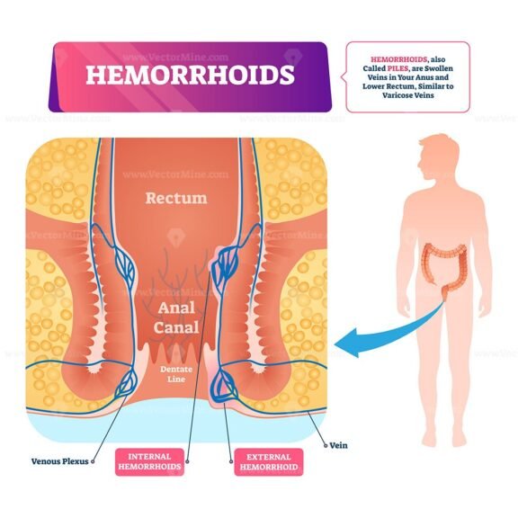 Hemorrhoids