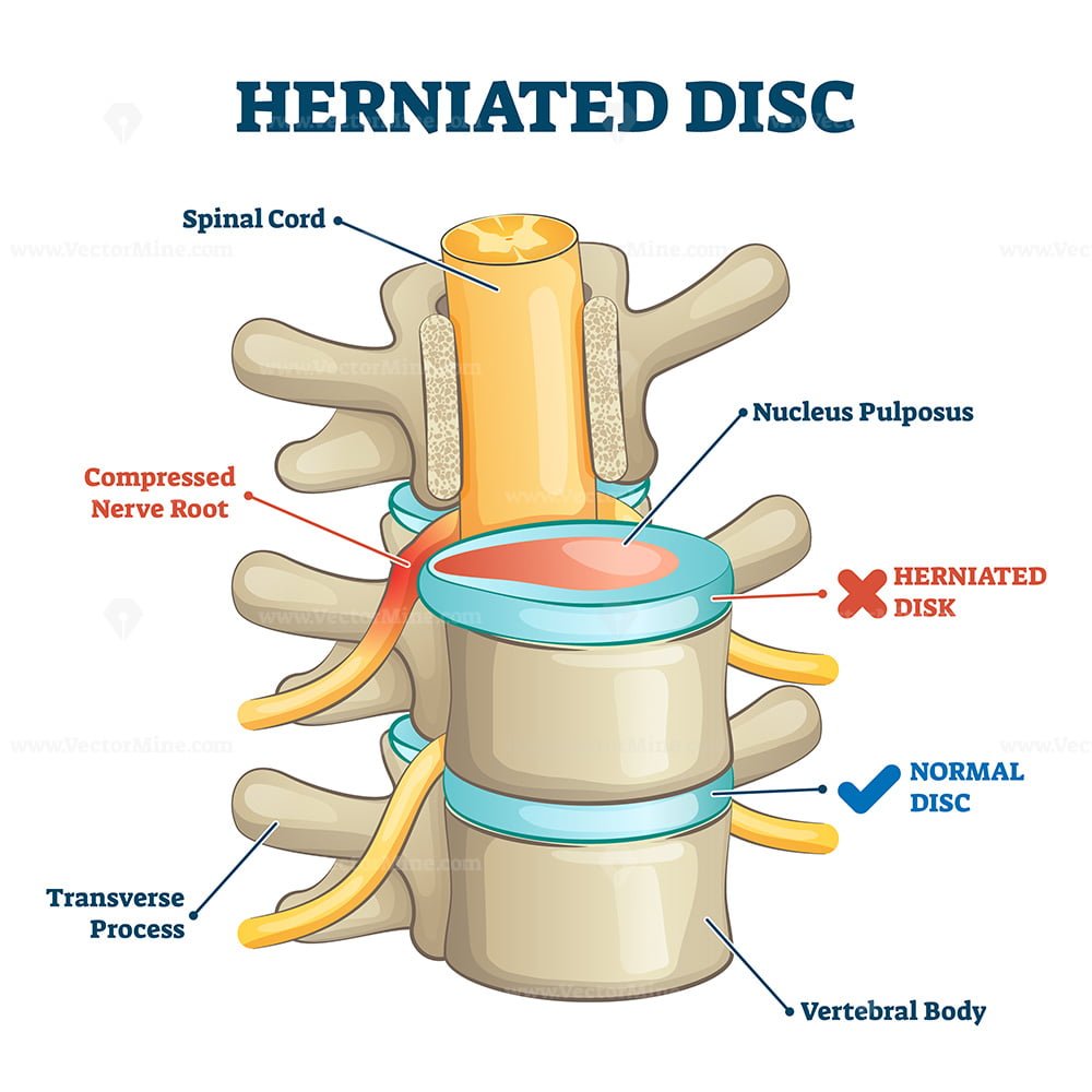 herniated-disc-injury-3d-side-view-on-spine-bone-skeleton-vector