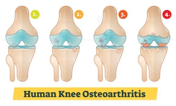 Human Knee Osteoarthritis