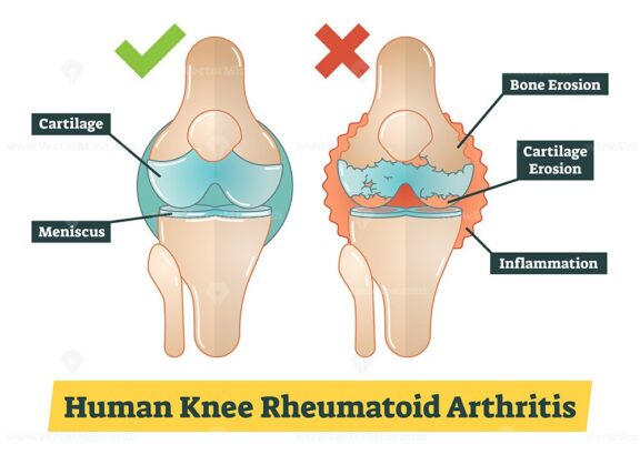 Human Knee Rheumatoid Arthritis