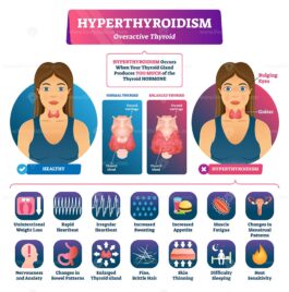 Hyperthyroidism vector illustration - VectorMine