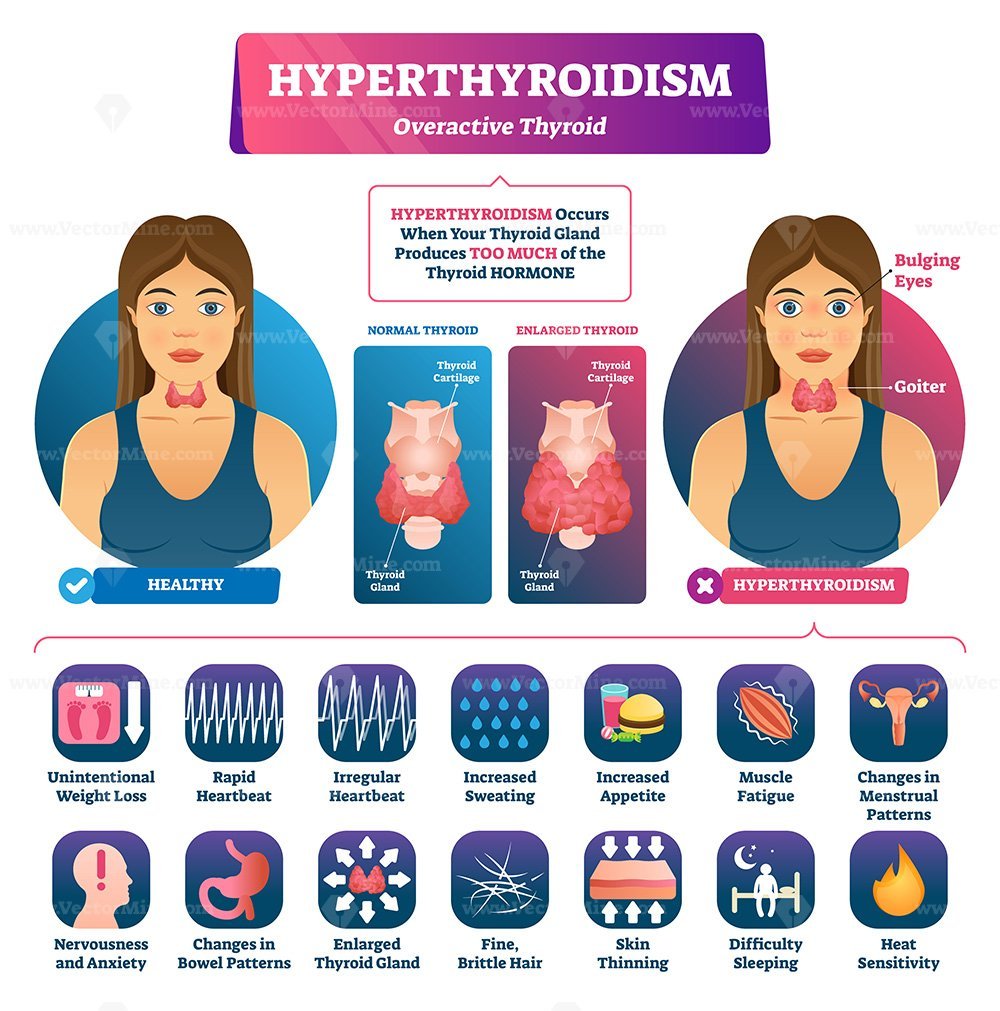 hyperthyroidism-vector-illustration-vectormine