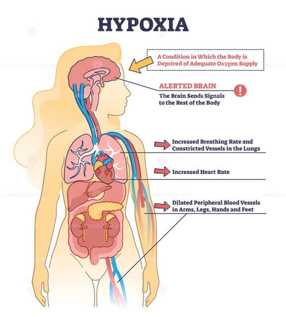 Hypoxia condition as lack of oxygen in brain cells or tissues outline diagram