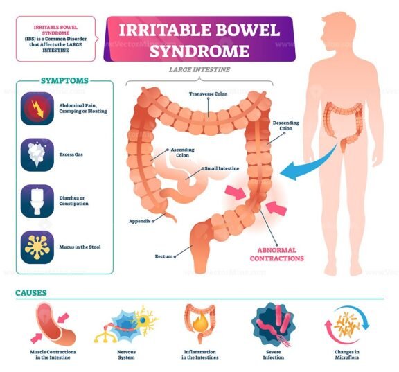 Irritable Bowel Syndrome