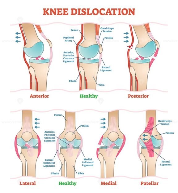 Knee Dislocation