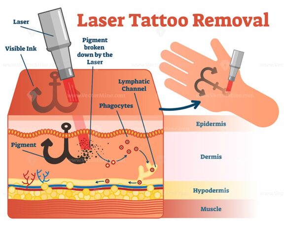 Laser tattoo removal vector illustration diagram