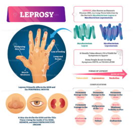 Leprosy Vector Illustration – Vectormine