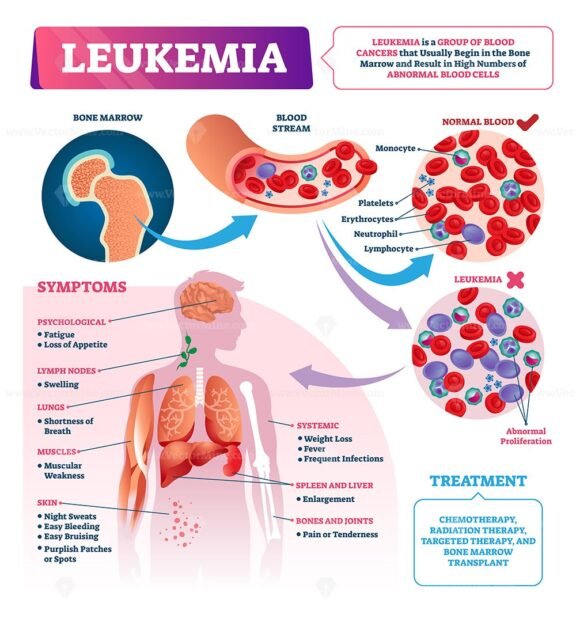 Leukemia vector illustration – VectorMine