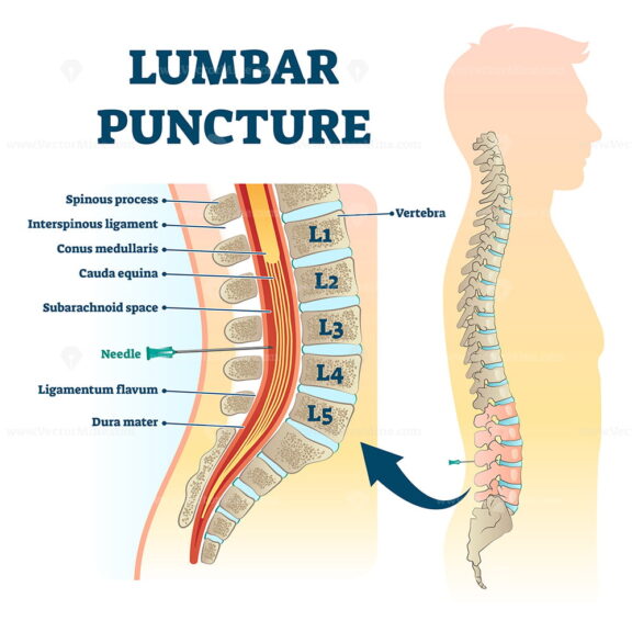 Lumbar puncture vector illustration