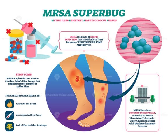 MRSA super bug vector illustration