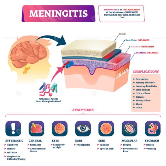 Meningitis