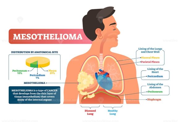 Mesothelioma vector illustration