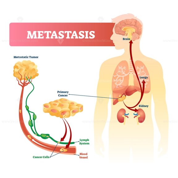 Metastasis