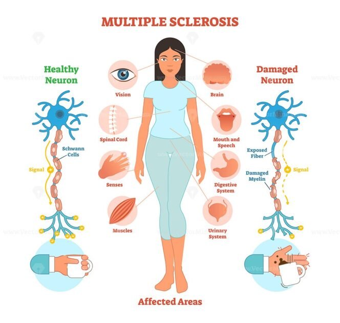 Multiple Sclerosis Anatomical Vector Illustration Diagram Medical   Multiple Sclerosis 664x631 