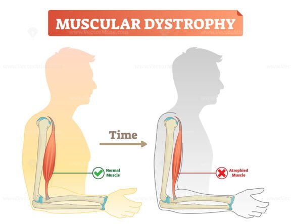 Muscular Dystrophy