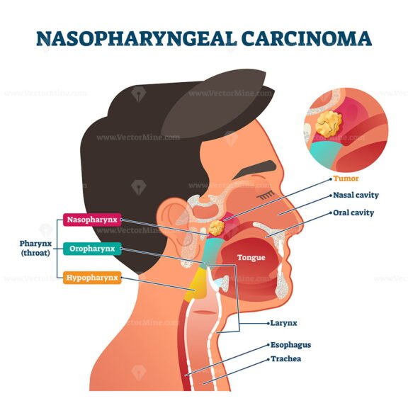 Nasopharyngeal Carcinoma