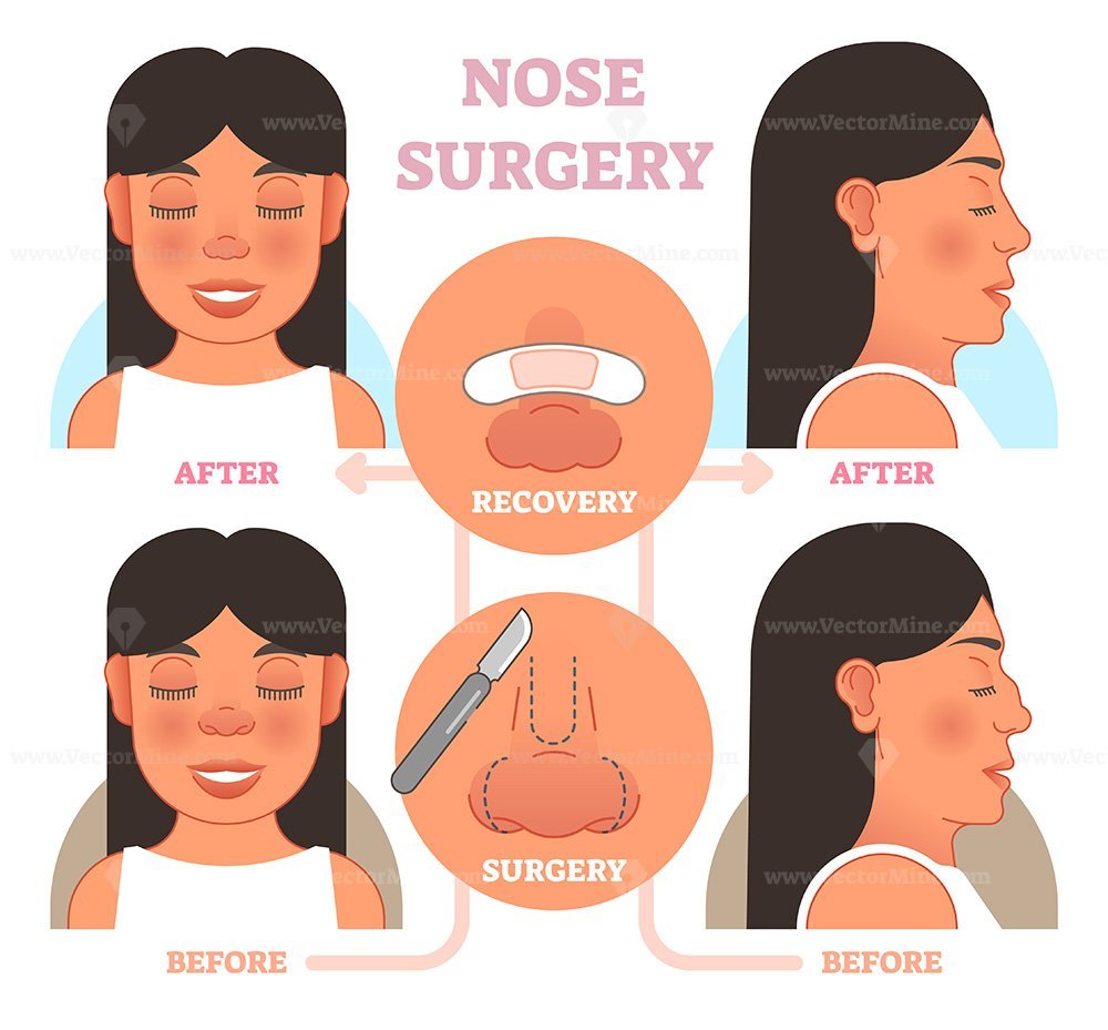 FREE Nose plastic surgery vector illustration – VectorMine