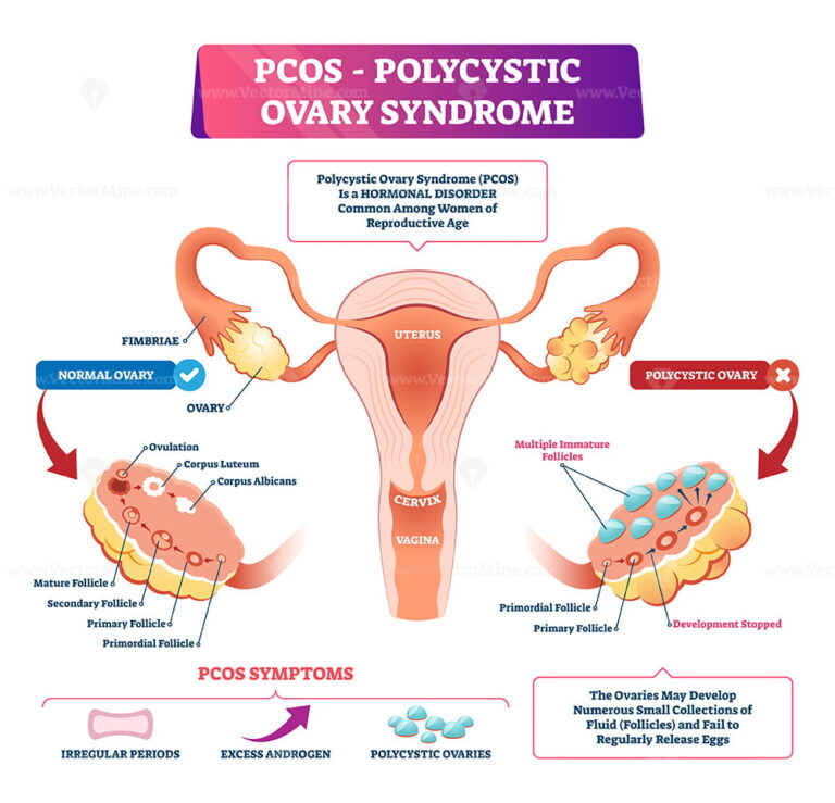 Polycystic Ovary Syndrome Vector Illustration Vectormine