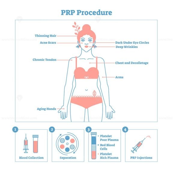 PRP procedure linestyle