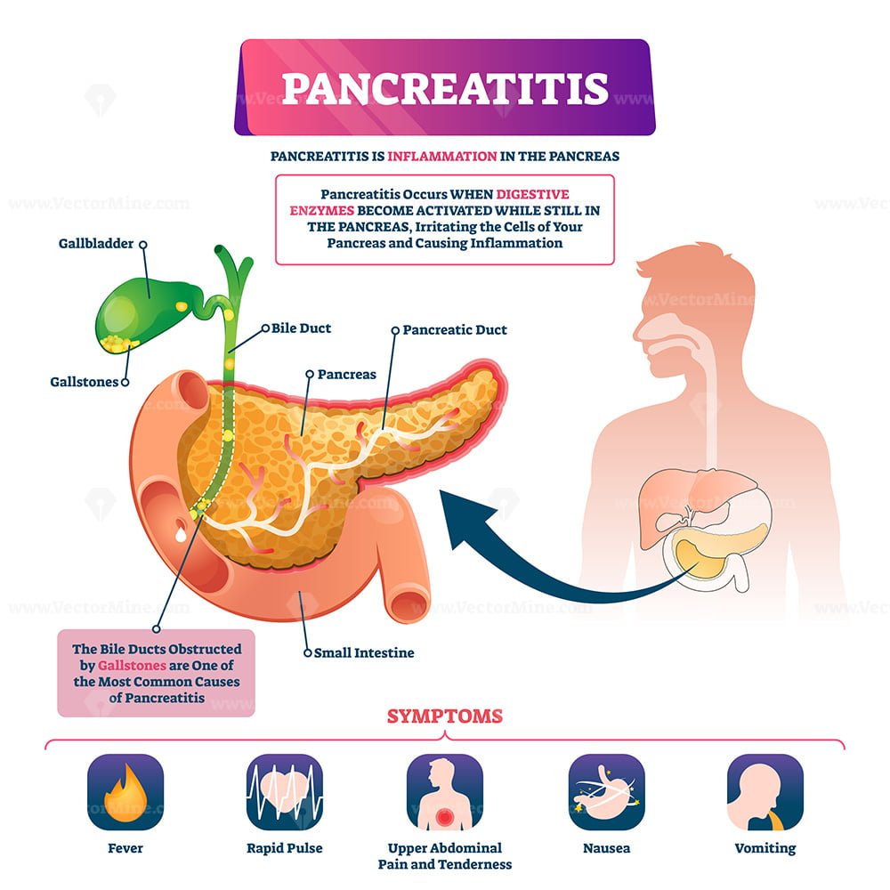 Pancreatitis Vector Illustration Vectormine