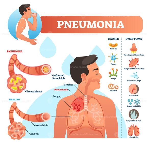 Pneumonia