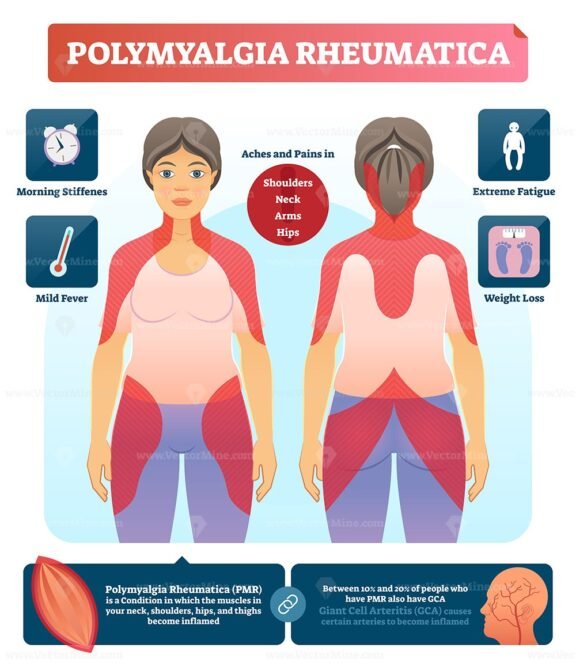 Polymyalgia Rheumatica