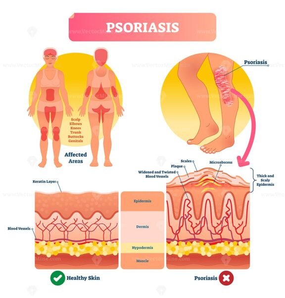 Psoriasis