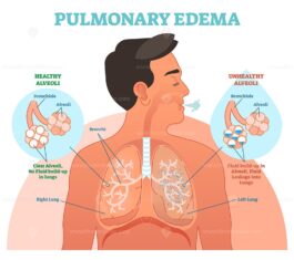 Pulmonary edema, lung problem vector illustration diagram – VectorMine