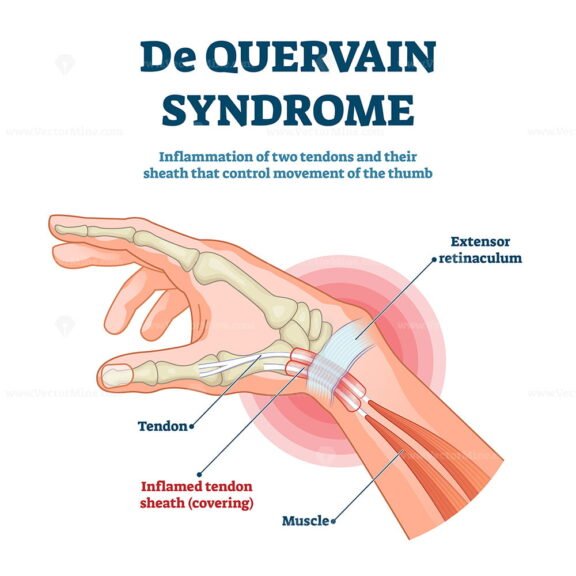 Quervain Syndrome