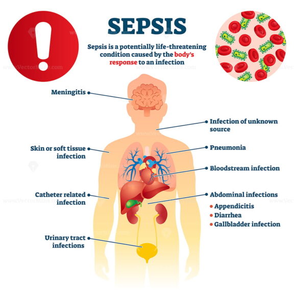 SEPSIS