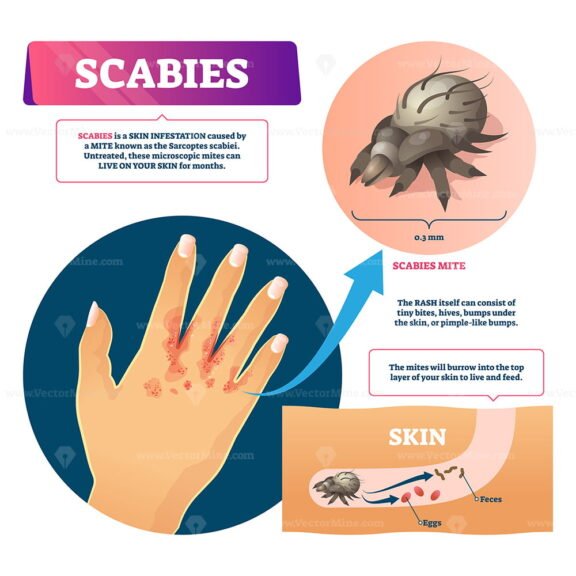 Scabies