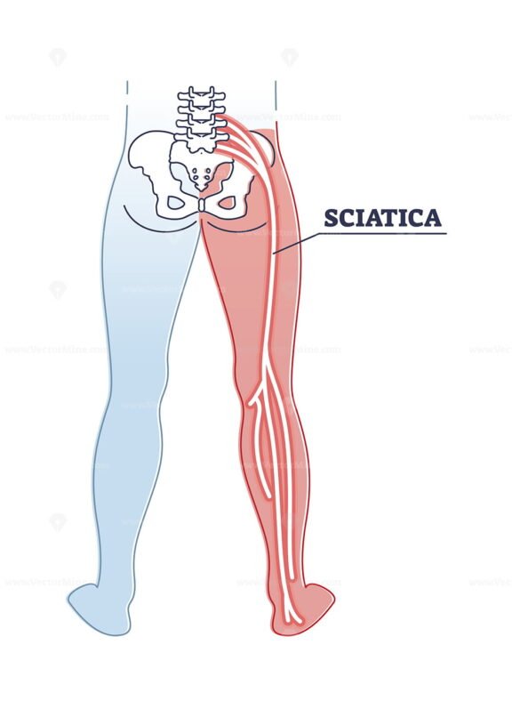 Sciatica 2 outline