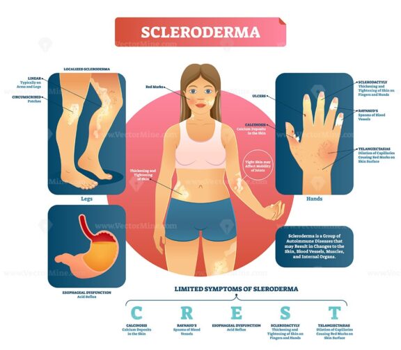 Scleroderma vector illustration