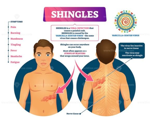 Shingles