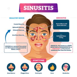 Sinusitis vector illustration - VectorMine